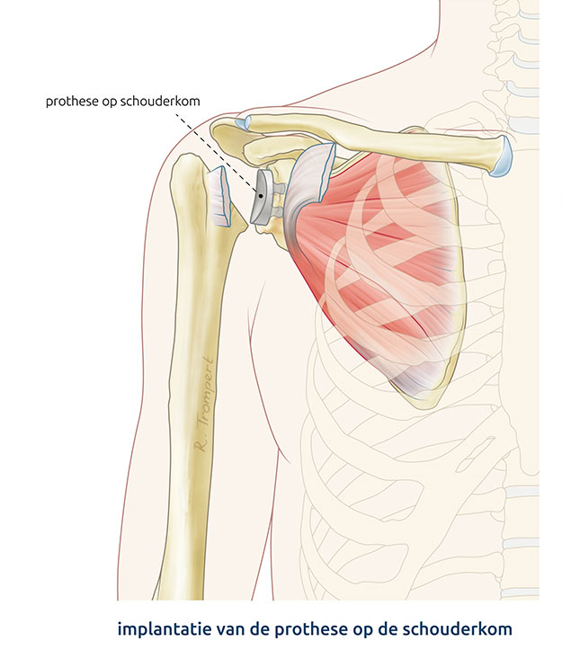 Afbeelding van een schouderprothese operatie waarbij de kom van een anatomische schouderprothese is ingebracht.