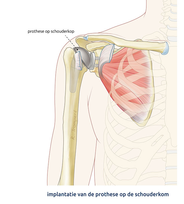 Afbeelding van een schouderprothese operatie waarbij de kop en steel van een anatomische schouderprothese is ingebracht.  