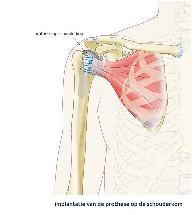 Afbeelding van een anatomische schouderprothese operatie waarbij, nadat de prothese is geplaatst, de subscapularispees wordt teruggehecht aan de schouderkop.