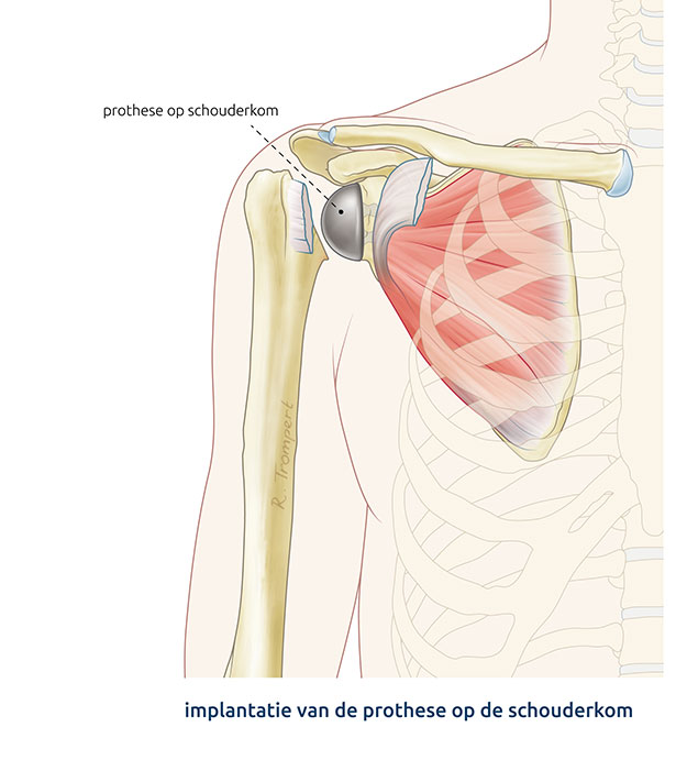 Afbeelding van een omgekeerde schouderprothese operatie waarbij de bol op de schouderkom is aangebracht.   