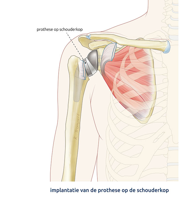 Afbeelding van een omgekeerde schouderprothese operatie waarbij de steel en kom in de bovenarm zijn aangebracht. 