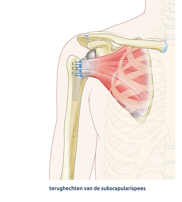 Afbeelding van een reversed schouderprothese operatie waarbij, nadat de prothese is geplaatst, de subscapularispees wordt teruggehecht aan de schouderkop.   