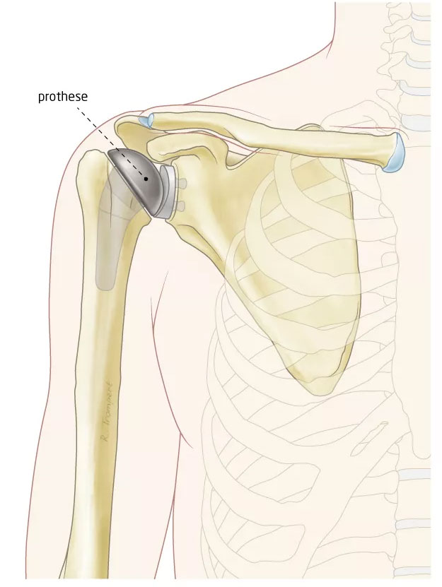 Schouder met een anatomische schouderprothese: een plastic kom en een metalen kop