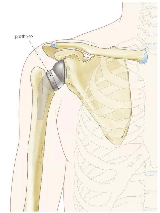 Schouder met een omgekeerde schouderprothese: een metalen bol in het schouderblad en een steel met holle plastic kom in de bovenarm