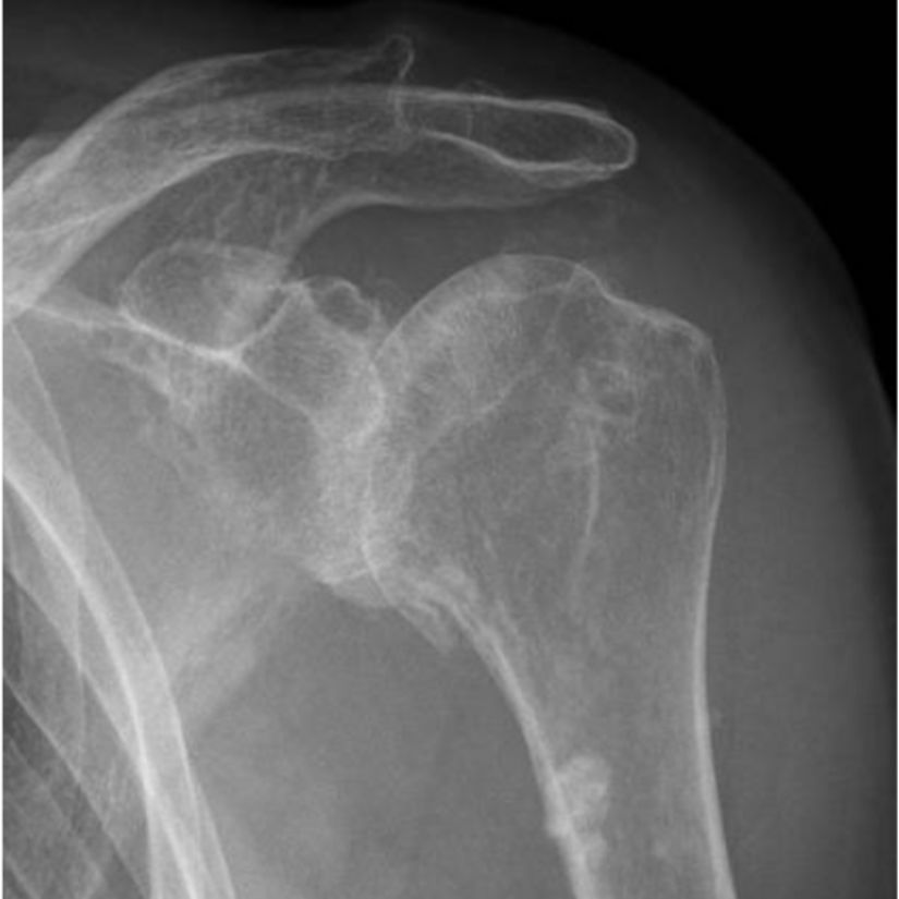 rontgenfoto van een versleten schouder met artrose. Het is ‘bot-op’bot’. Het kraakbeen van de schouderkop en schouderkom is weggesleten.