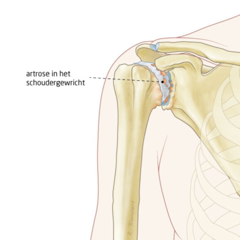 Slijtage van het kraakbeen van het schoudergewricht. Daardoor worden de botten ook hobbelig (niet glad) van vorm.
