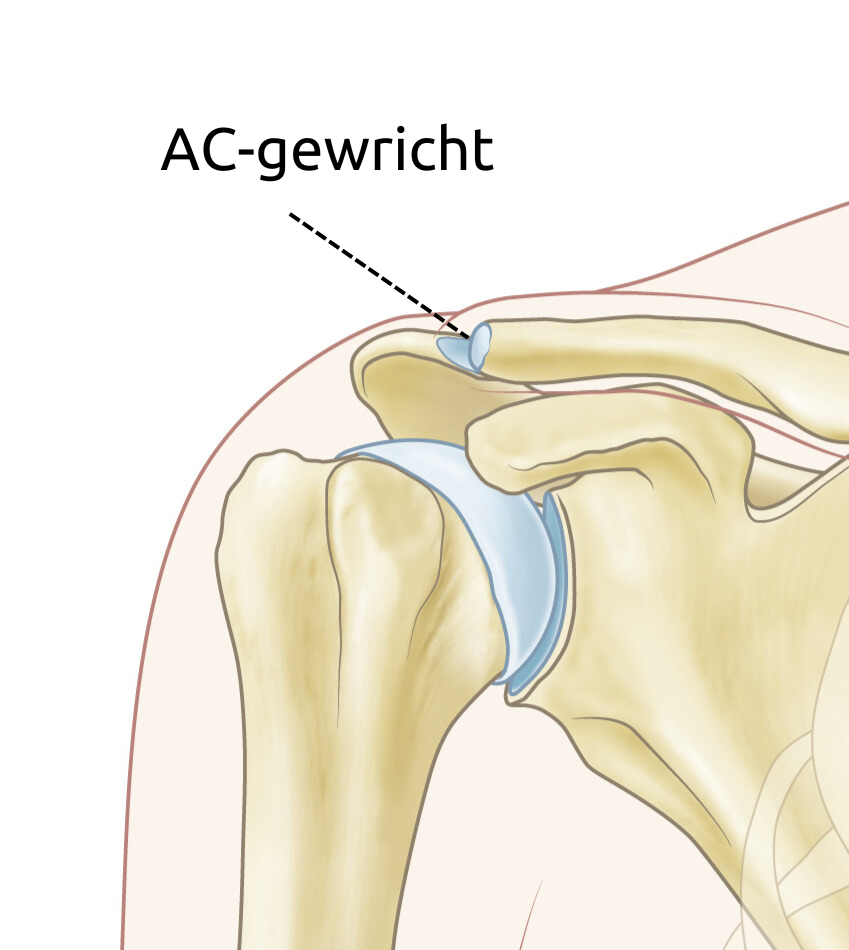 het AC-gewricht is de verbinding tussen het sleutelbeen en het schouderdak. Het zit bovenop de schouder