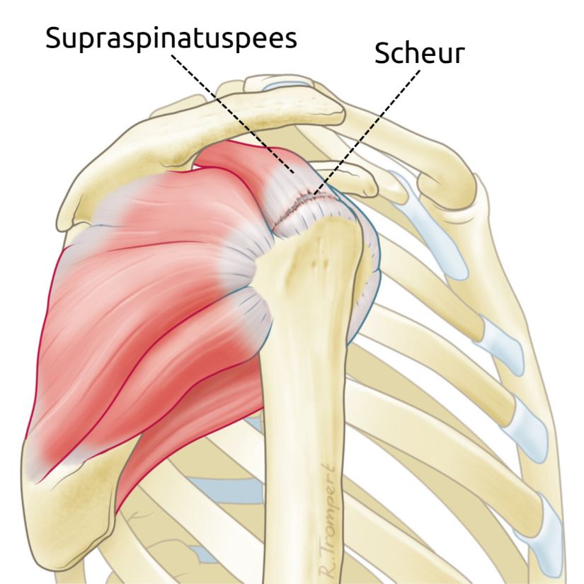 zij-aanzicht van het meest voorkomende type cuffruptuur van de supraspinatuspees van de schouder