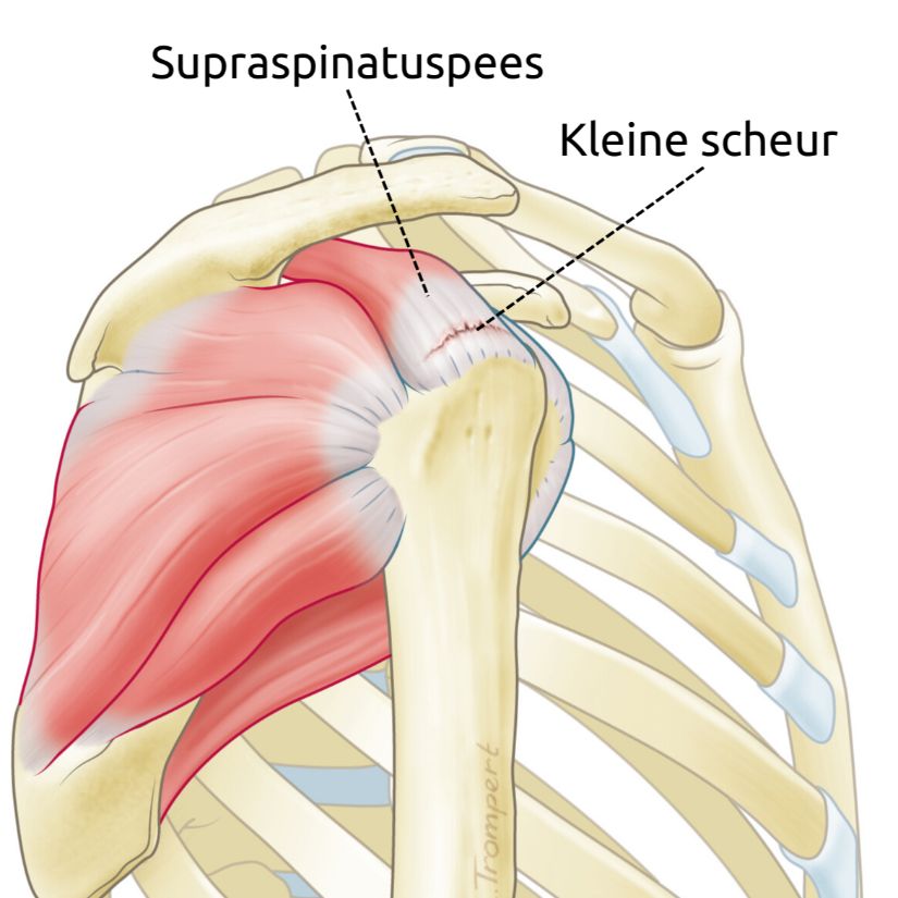 zij-aanzicht van een kleine cuffruptuur van de supraspinatuspees van de schouder