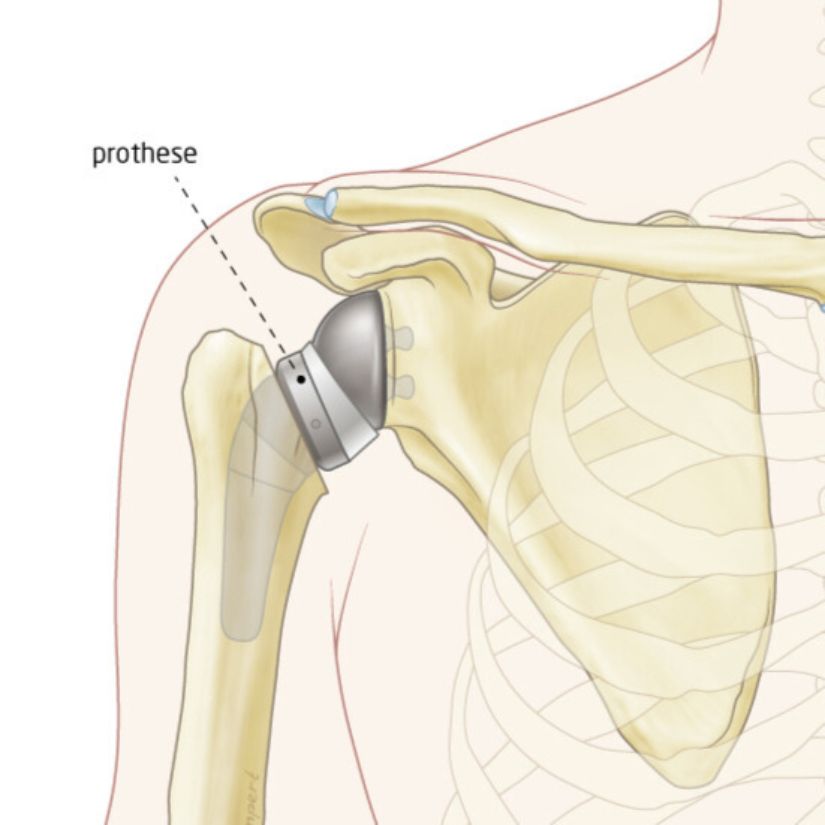 afbeelding van omgekeerde schouderprothese
