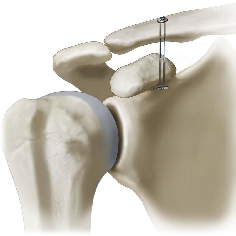Operatie voor AC-luxatie, waarbij het sleutelbeen weer op de goede plek wordt gebracht door een stevige hechtdraad en metalen plaatjes.