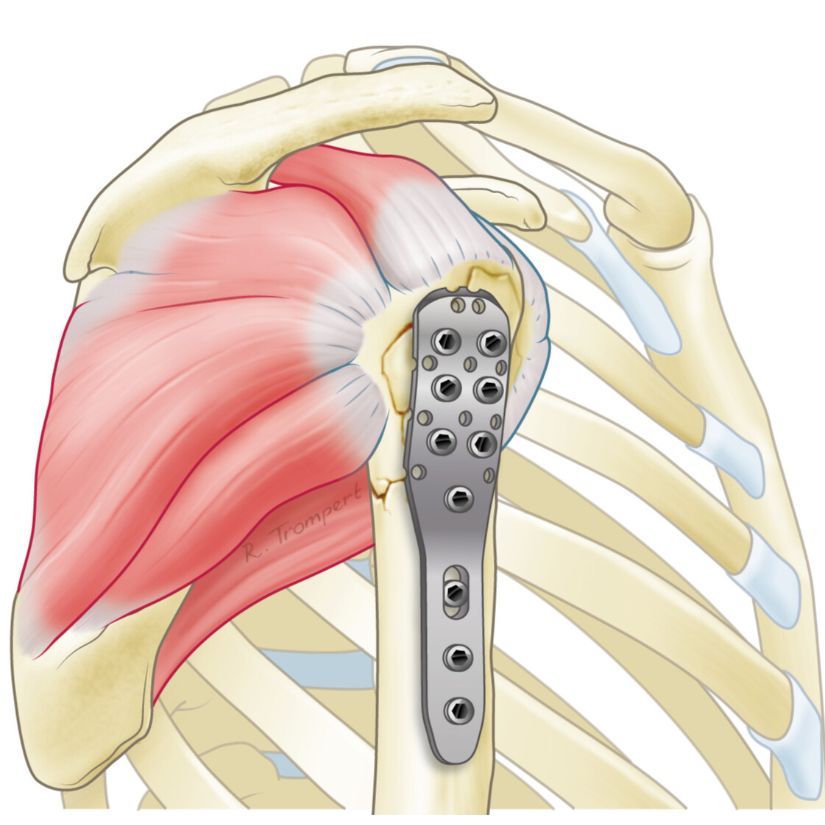 Figuur van een operatie waarbij een breuk van de schouderkop is gerepareerd met een plaat en schroeven. De schouderkop staat weer mooi op het bovenarmbeen.