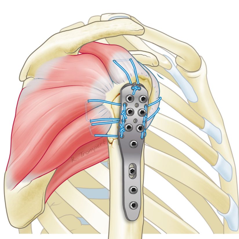 iguur van een operatie waarbij een breuk van de schouderkop is gerepareerd met een plaat en schroeven. De pezen van de schouderkop worden met stevige hechtingen aan de plaat vastgemaakt.