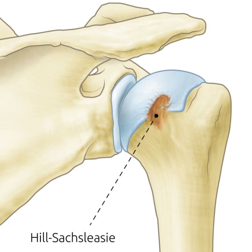 tekening van een Hill-Sachs lesie. Dat is een deuk in de achterkant van de schouderkop, die is ontstaan doordat de schouder uit de kom is geweest.