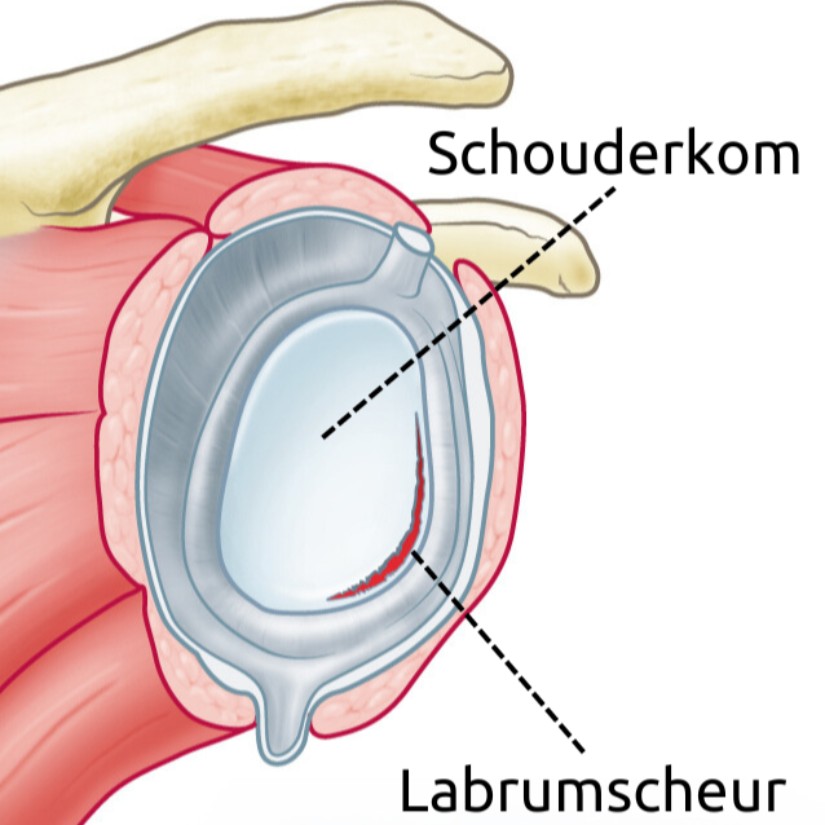 figuur van gescheurd labrum in een schoudergewricht. Het labrum scheurt samen met het kapsel af van het bot van de schouderkom.