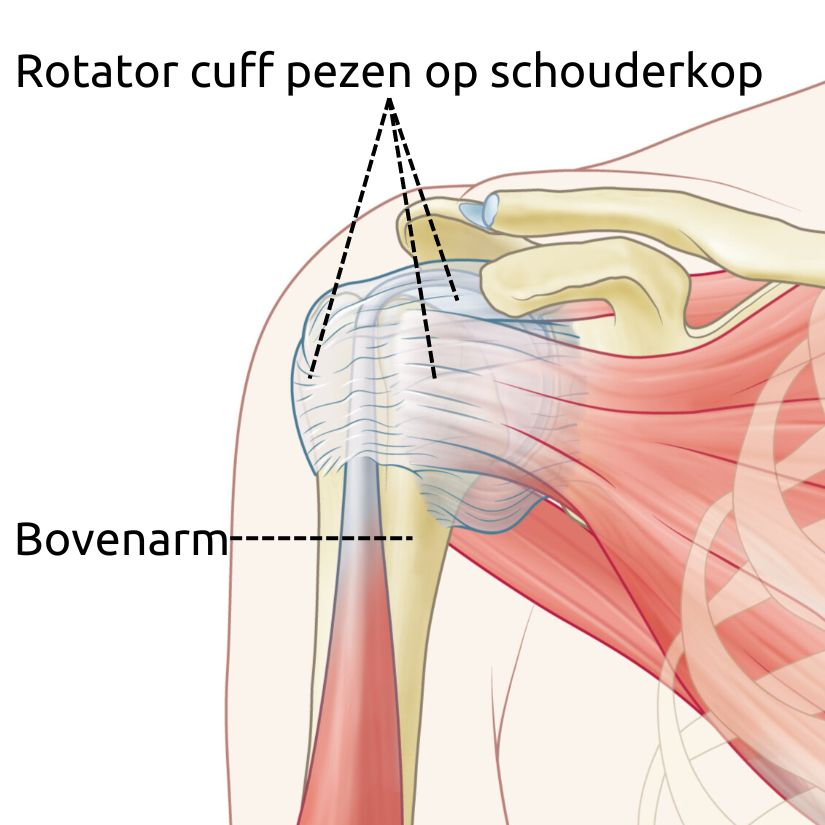 Bij een peesonsteking van de schouder zijn vaak de pezen van de schouderkop ontstoken of geïrriteerd.