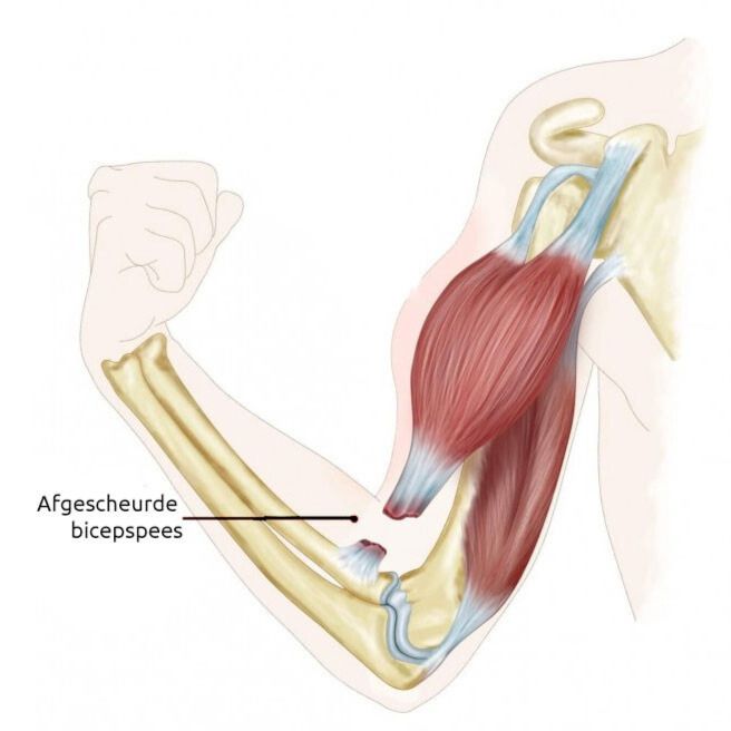 Tekening van operatie voor een gescheurde bicepspees bij de elleboog (ook wel distale biceps repair). De gescheurde pees is vastgezet in het bot met stevige hechtdraden en een metalen plaatje.